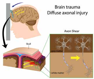 פגיעת מוח מפושטת (Diffuse Axonal Injury) - תנועה חדה של המוח בתוך הגולגולת גורמת לקריעת סיבי עצב; ילדים חשופים לכך יותר בגלל פחות הגנה של נוזל השדרה.