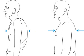 חזה חביתי (Barrel Chest) - נוצר מאוויר כלוא בבית החזה