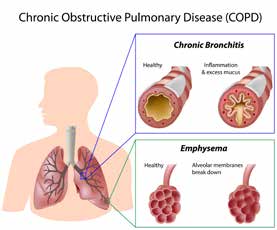 COPD - ברונכיטיס כרונית (עודף ליר ודלקת) מול אמפיזמה (הרס מחיצות נאדיות)