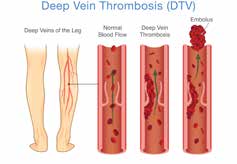 היווצרות קריש בוורידי הרגליים העמוקים (DVT) והשתחררותו כתסחיף ריאתי (PE)