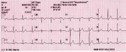 אק"ג תקין בקצב סינוס - גל P לפני כל QRS, מרווח PR קבוע, קצב סדיר