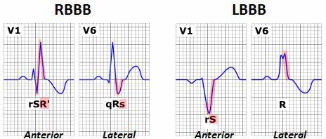 השוואת תבניות RBBB ו-LBBB בלידים V1 ו-V6