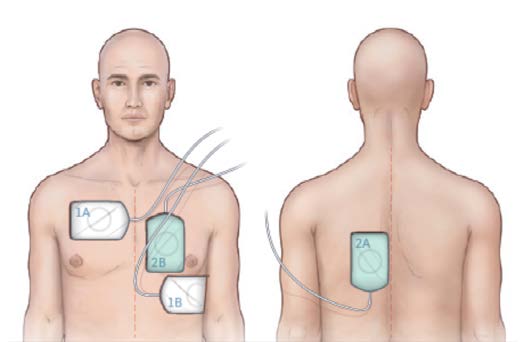 Double Sequence External Defibrillation - שני מכשירים, וקטורים צולבים