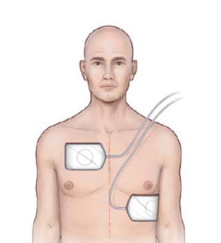 Standard Defibrillation - מיקום סטנדרטי