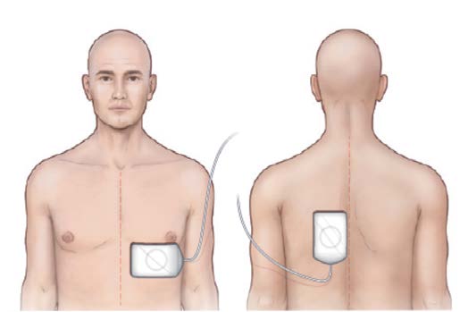 Vector Change Defibrillation - וקטור שונה
